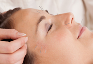 cosmetic-acupuncture.jpg